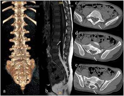 Spina Bifida Occulta Is a Risk Factor for Spinal Cord Injury Without Fracture or Dislocation for Children Performing a Backbend During Dance